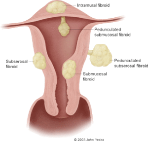 Type of Uterine Fibroids
